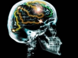Alzheimer y la proteína Tau