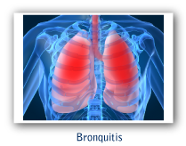 Bronquitis