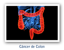 Cáncer   de colon