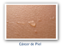 Cáncer de piel