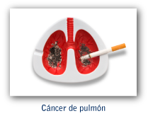 Cáncer de pulmón